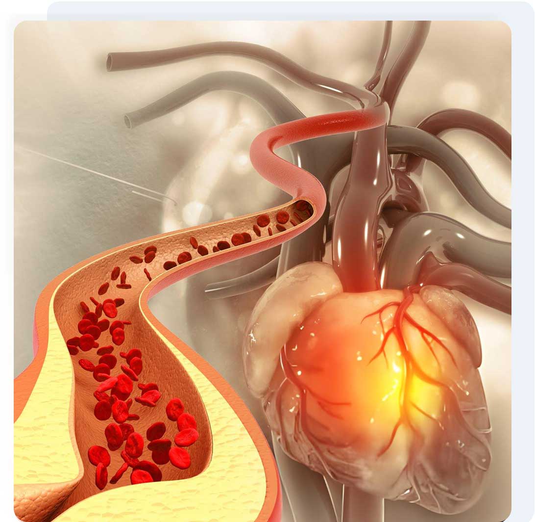 Cholesterol & Dyslipidemia