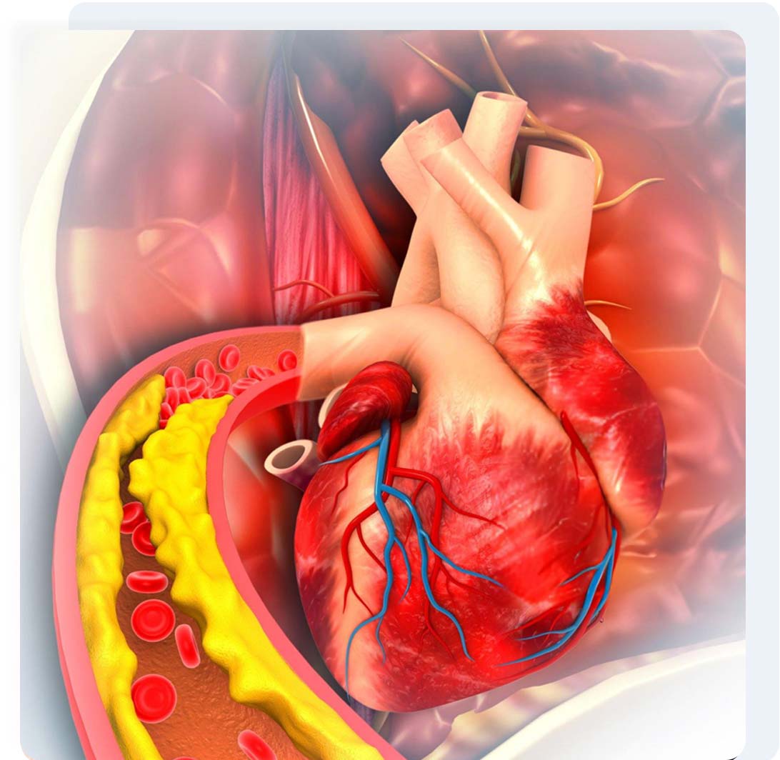 Cholesterol & Dyslipidemia