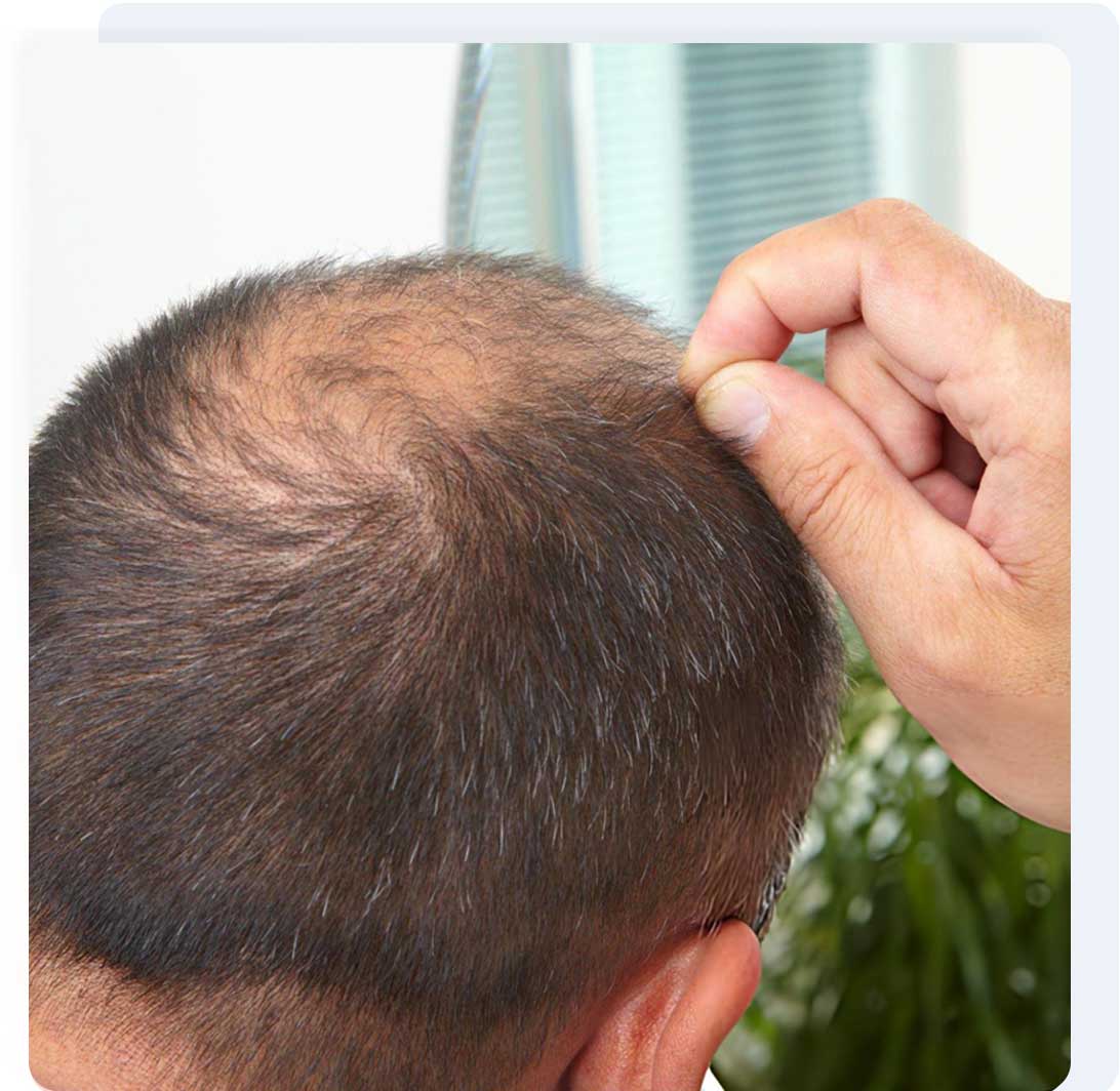 Hair loss