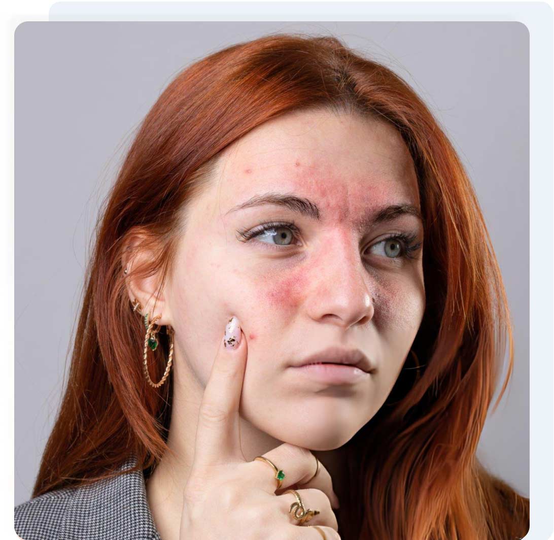 Rosacea