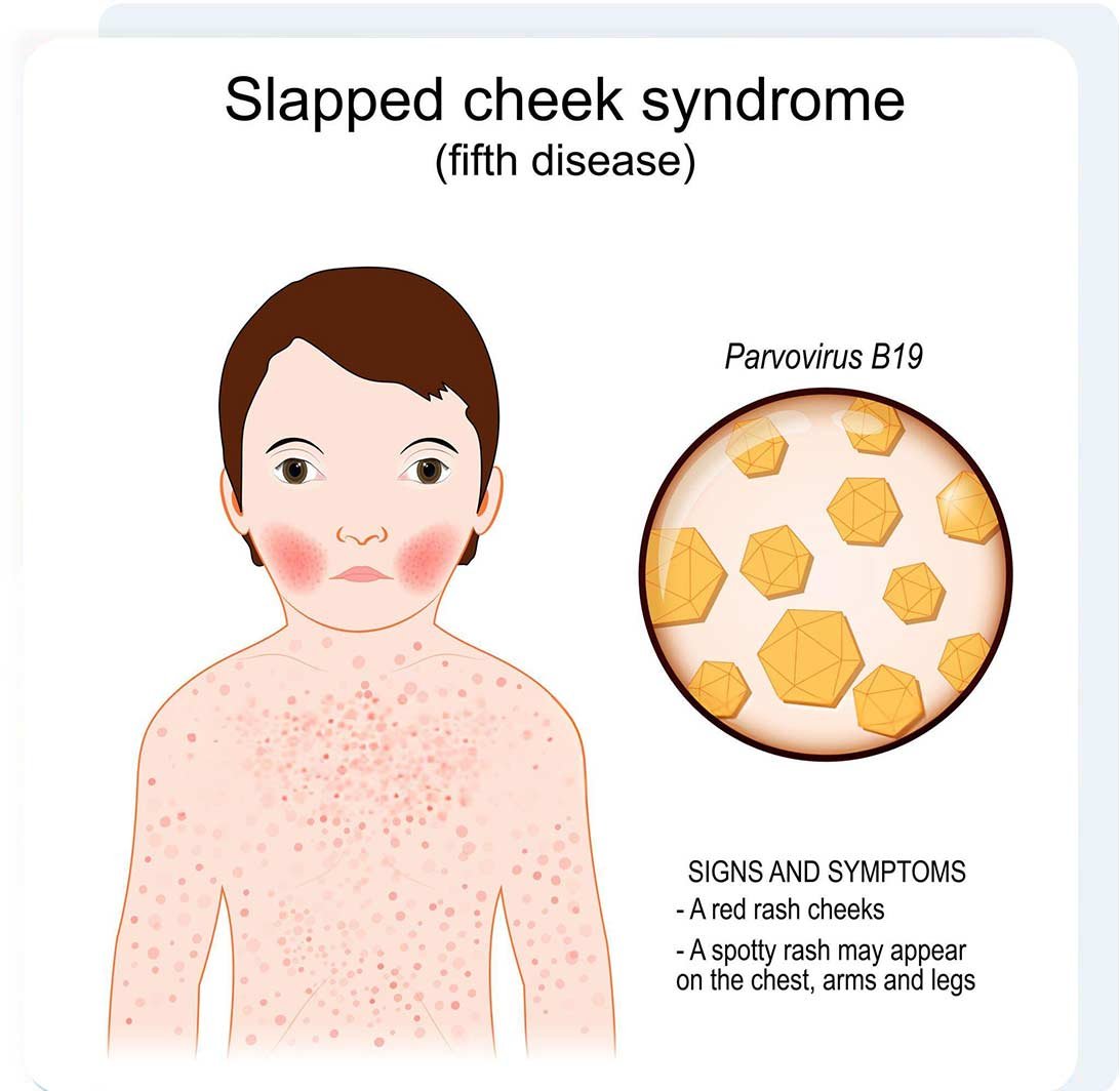 pavovirus-(5th-disease)
