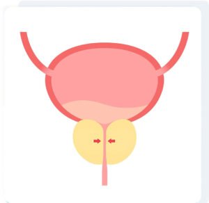 Enlarged Prostate