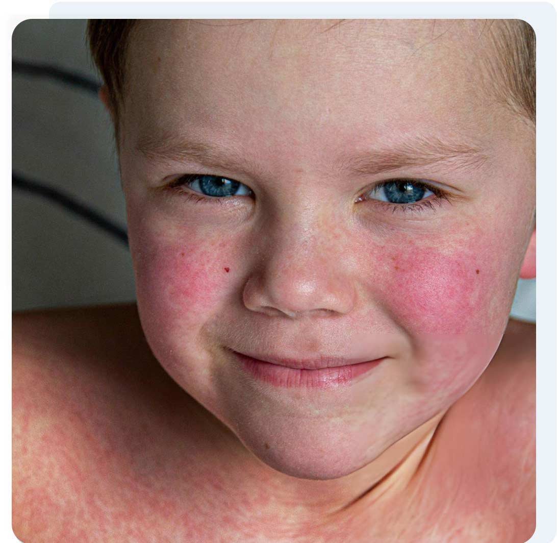 parvovirus-fifth-disease-treatment-online-book-telehealthdr