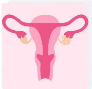 Polycystic Ovary Syndrome