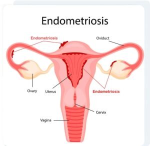 Endometriosis