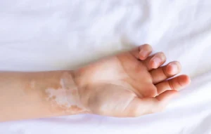 5 Common Skin Conditions You Can Get Online Prescriptions For